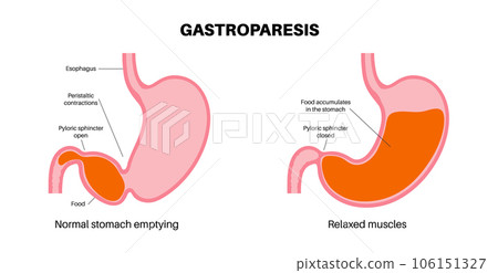 Gastroparesis anatomical poster Gastroparesis anatomical poster 106151327