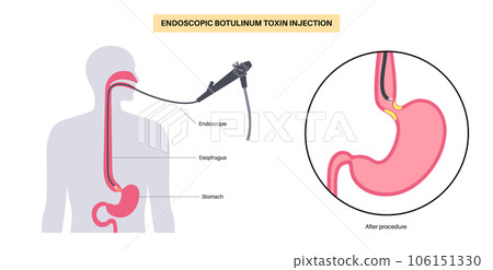 esophageal botulinum toxin injection 106151330