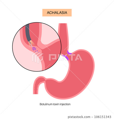 esophageal botulinum toxin injection 106151343