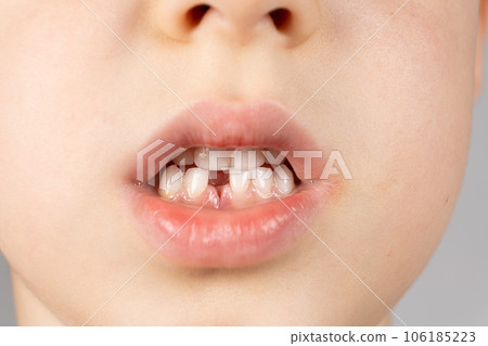 Loss of milk teeth in children. A six-year-old child shows the first baby tooth that has fallen out Loss of milk teeth in children. A six-year-old child shows the first baby tooth that has fallen out 106185223