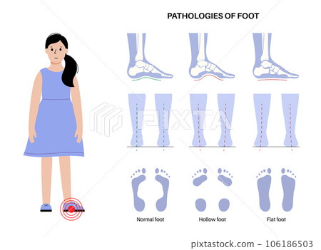 Foot pathologies poster 106186503