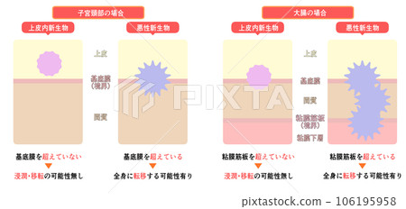 Difference Between Intraepithelial Neoplasm and Malignant Neoplasm Difference Between Intraepithelial Neoplasm and Malignant Neoplasm 106195958