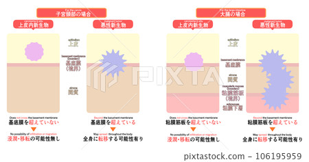 上皮內腫瘤與惡性腫瘤的區別 106195959