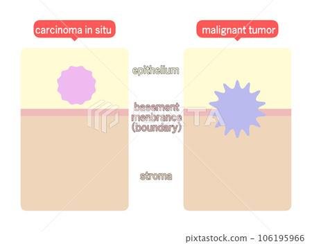 Difference Between Intraepithelial Neoplasm and Malignant Neoplasm 106195966