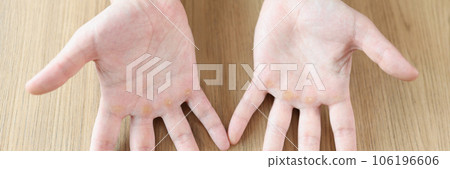 Many calluses on distal palmar surface of hands. 106196606