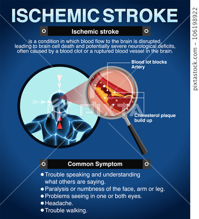 Informative poster of Ischemic stroke Informative poster of Ischemic stroke 106198922
