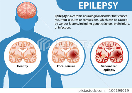 Informative poster of Epilepsy 106199019