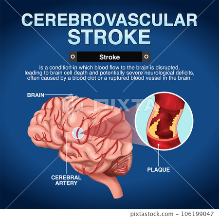 Informative poster of Cerebrovascular stroke05 106199047