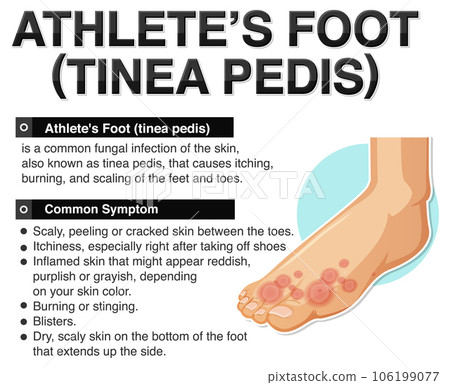 Informative poster of Athlete foot 106199077