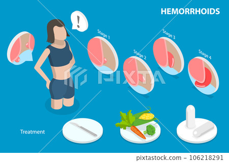 3D Isometric Flat Vector Conceptual Illustration of Hemorrhoids 106218291