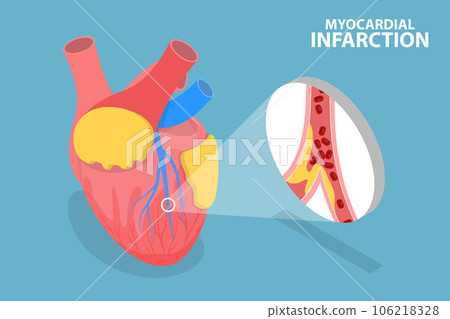 3D Isometric Flat Vector Conceptual Illustration of Myocardial Infarction 3D Isometric Flat Vector Conceptual Illustration of Myocardial Infarction 106218328