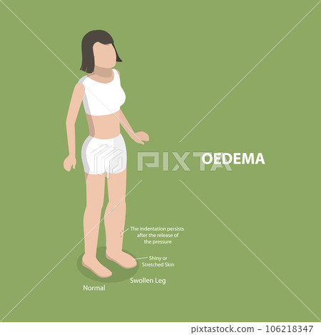 3D Isometric Flat Vector Conceptual Illustration of Oedema 3D Isometric Flat Vector Conceptual Illustration of Oedema 106218347