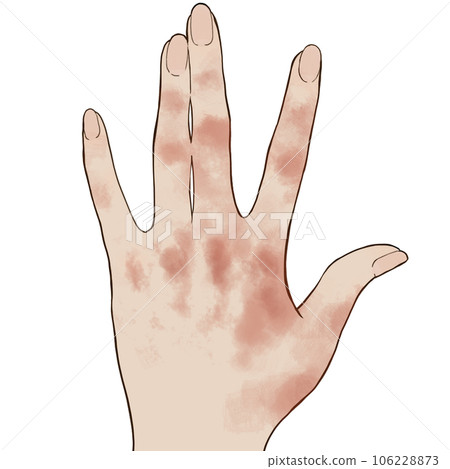 手部濕疹圖片 106228873