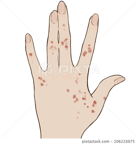 起水泡的濕疹插畫 106228875