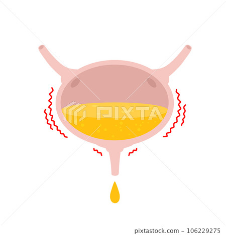 Overactive bladder. Urinal overflow. Stress signal, disorder and medical dysfunction of human body. Anatomical illustration isolated on white 106229275