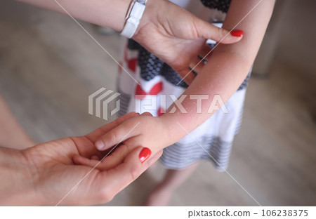 Sunburn redness and peeling of skin on child hand closeup 106238375