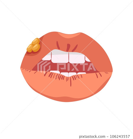 Lips with herpes. Infectious disease affecting mucous membranes Lips with herpes. Infectious disease affecting mucous membranes 106243557