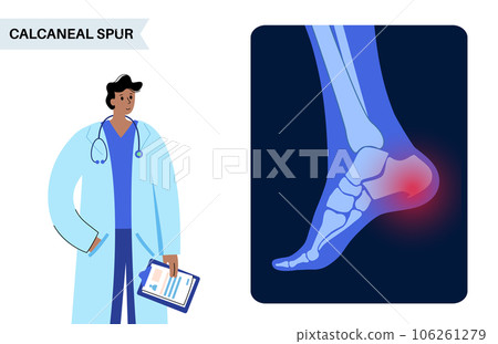 Heel spur poster 106261279