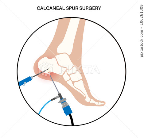 Heel spur surgery 106261309