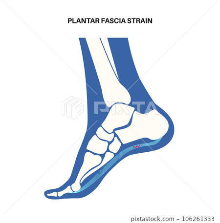 Plantar fascia strain Plantar fascia strain 106261333