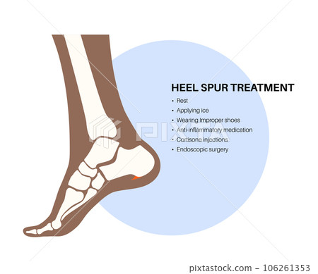 Heel spur treatment 106261353