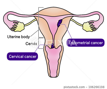單純性子宮內膜癌和宮頸癌圖解 單純性子宮內膜癌和宮頸癌圖解 106266108