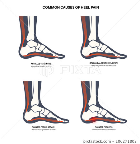 Heel pain diagram 106271802