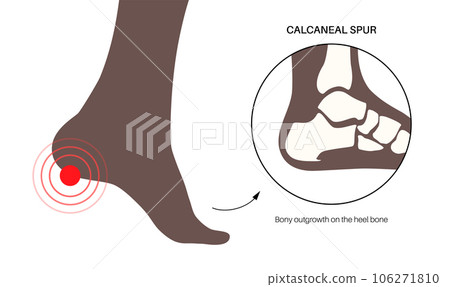 Heel spur poster 106271810