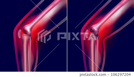 Arthrosis medical illustration diagram with damaged knee structure and healthy knee comparison. Bone exposure, osteophytes, cartilage fragments, erosion of cartilage and inflamed joint capsule. Arthrosis medical illustration diagram with damaged knee structure and healthy knee comparison. Bone exposure, osteophytes, cartilage fragments, erosion of cartilage and inflamed joint capsule. 106297204