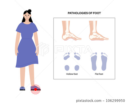 Foot pathologies poster 106299950