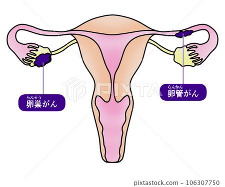 Simple illustration of ovarian cancer and fallopian tube cancer Simple illustration of ovarian cancer and fallopian tube cancer 106307750