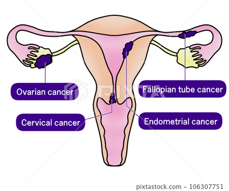 Simple illustration of cervical cancer, endometrial cancer, ovarian cancer and fallopian tube cancer Simple illustration of cervical cancer, endometrial cancer, ovarian cancer and fallopian tube cancer 106307751