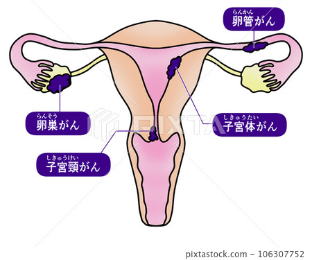宮頸癌、子宮內膜癌、卵巢癌、輸卵管癌的簡單圖解 106307752
