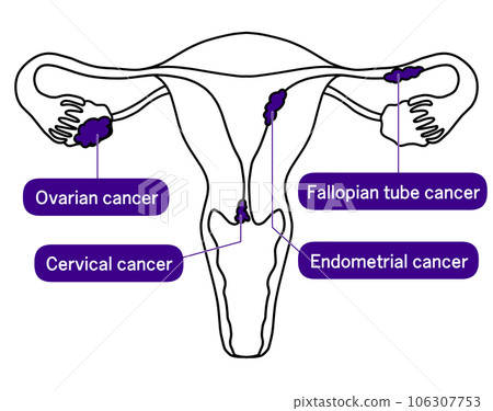 Simple illustration of cervical cancer, endometrial cancer, ovarian cancer and fallopian tube cancer 106307753