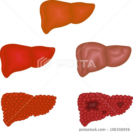 Liver disease condition illustration 106308956