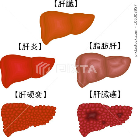 肝臟疾病狀況圖日語 106308957