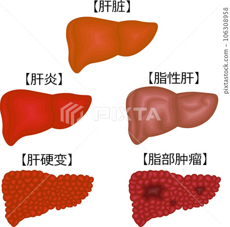 肝臟疾病狀況圖解中文 106308958
