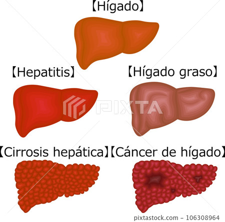 Liver disease condition illustration Spanish 106308964