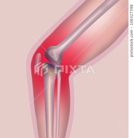 Joint pain, knee pain icon or medical illustration 106327398