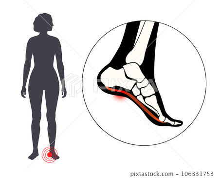 Pain of the heel 106331753