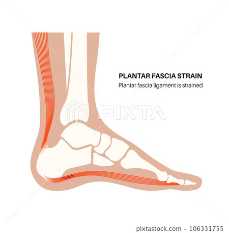 Plantar fascia strain Plantar fascia strain 106331755
