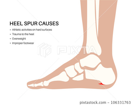 Heel spur causes 106331763