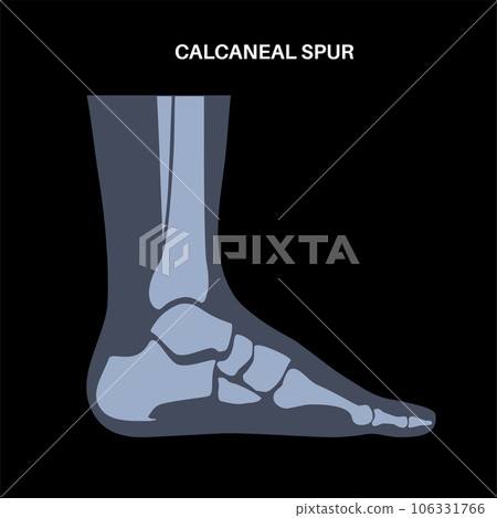 Heel spur poster Heel spur poster 106331766