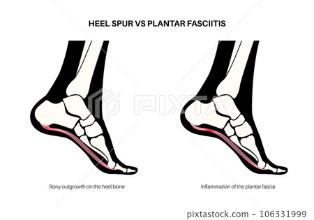 Heel spur and plantar fasciitis Heel spur and plantar fasciitis 106331999