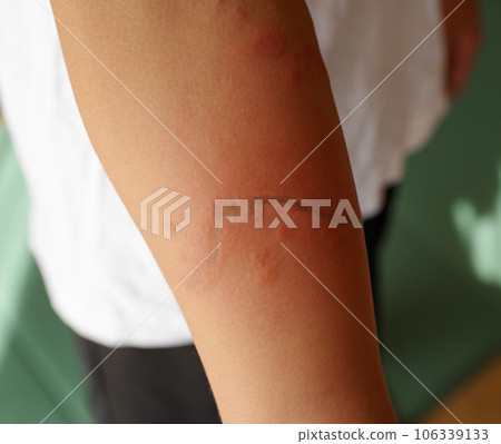 手臂被水母咬傷的疤痕 手臂被水母咬傷的疤痕 106339133