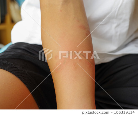 Jellyfish bite scar on arm Jellyfish bite scar on arm 106339134