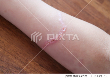 手臂被水母咬傷的疤痕 手臂被水母咬傷的疤痕 106339139