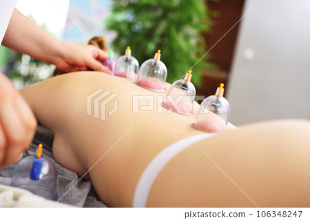 Hijama - method of vacuum bloodletting. The specialist makes cupping therapy for the patient. 106348247
