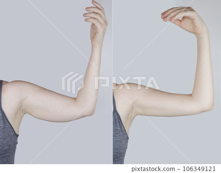 Obesity Cellulite. Sagging flabby skin on a woman arm. Before and after. Concept of losing weight, playing sports, checking result from diet and intense training. Result of losing weight. Liposuction 106349121