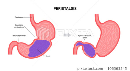 Gastroparesis anatomical poster Gastroparesis anatomical poster 106363245